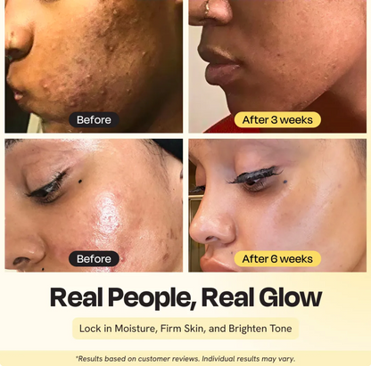 Before and after skin improvement results with text 'Real People, Real Glow' on a beige background.