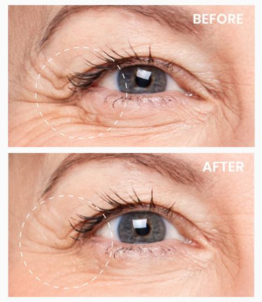 Depology Deepcare Plus Serum Infused Micro Dart Patches before and after on skin showing reduction in wrinkles and smoother surface